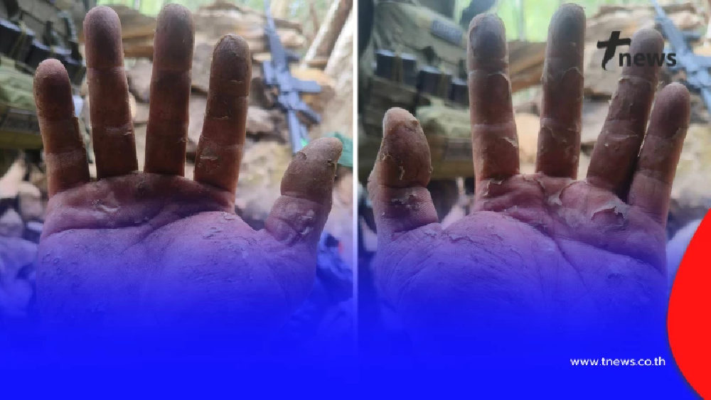 ทหารแนวหน้า เปิดสภาพมือของตนเอง หลังทำหน้าที่รักษาแผ่นดินไทย