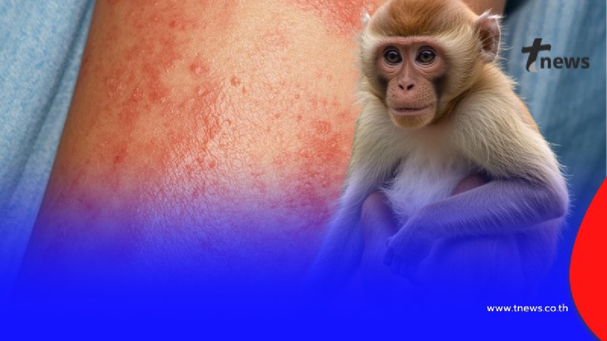 .จับตา เปิดชื่อจังหวัด อันดับ 3 ของไทย ป่วยฝีดาษวานร สะสม 50 รายแล้ว.