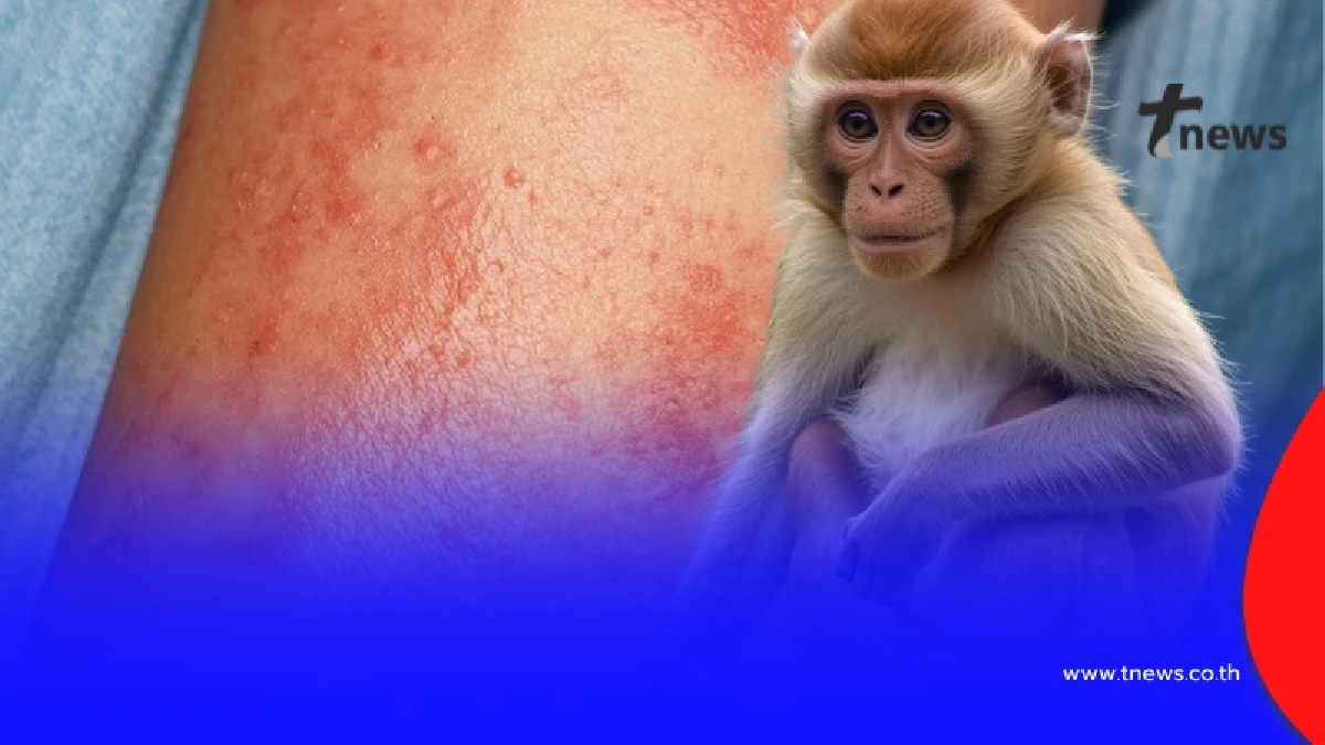 จับตา เปิดชื่อจังหวัด อันดับ 3 ของไทย ป่วยฝีดาษวานร สะสม 50 รายแล้ว