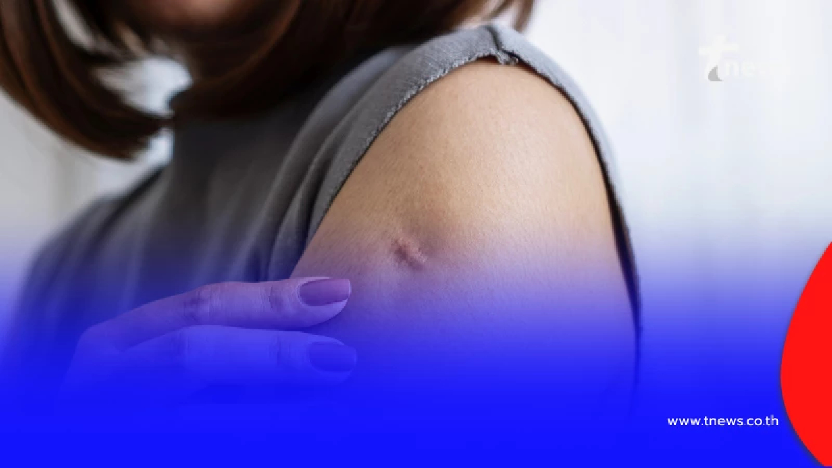 กทม.พบผู้ป่วยฝีดาษวานรสูงสุด รัฐบาลย้ำหลีกเลี่ยงพฤติกรรมเสี่ยง