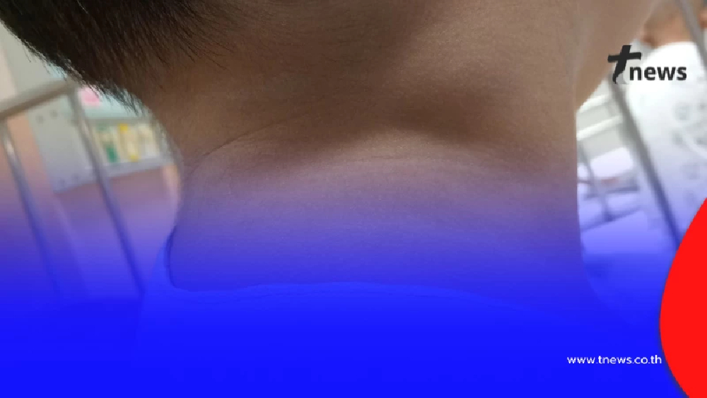 แม่เตือนภัย อย่ามองข้าม ก้อนเล็กๆ จุดเริ่มต้นมะเร็งลูกชาย