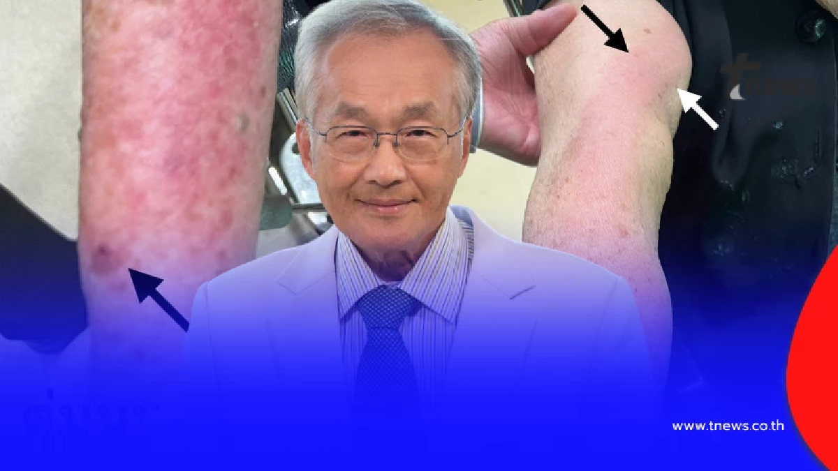 รู้จัก "โรคแมวข่วน" หมอโพสต์เตือน ใครเลี้ยงแมว ต้องรู้