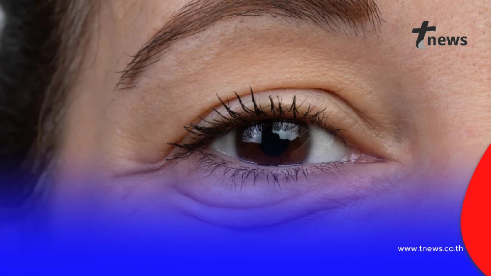 ผ่าตัดถุงใต้ตาเจ็บไหม มีวิธีการเตรียมตัวและดูแลตัวเองอย่างไร