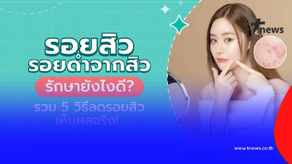 รวมวิธีรักษาเลเซอร์รอยสิวที่หลัง รอยดำจากสิวให้จางเร็ว เห็นผลจริง
