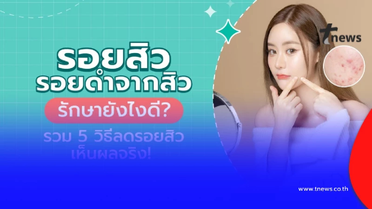 รวมวิธีรักษาเลเซอร์รอยสิวที่หลัง รอยดำจากสิวให้จางเร็ว เห็นผลจริง