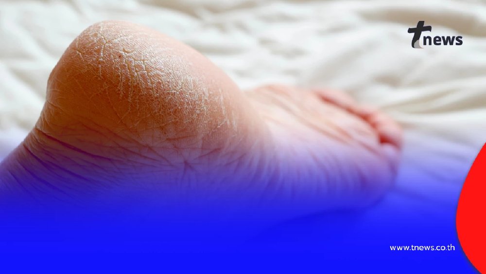 กู้ส้นเท้าแตกให้เนียนนุ่ม สูตรธรรมชาติ ทำง่ายที่บ้าน