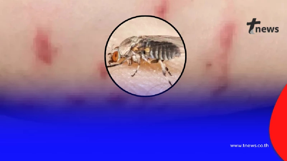 ถ้าโดน "ตัวคุ่น" กัด แล้วมีอาการดังนี้ ให้รีบไปหาหมอด่วน