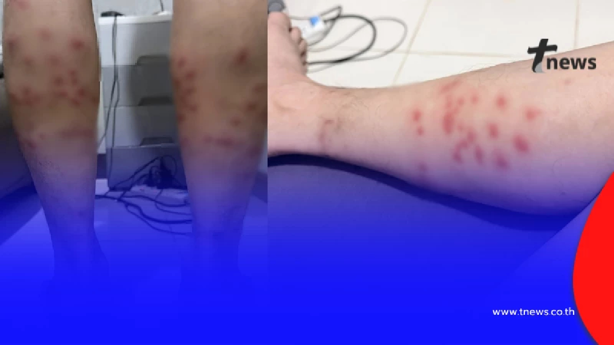 เตือน "ตัวคุ่น" แมลงจิ๋วพิษร้าย กัดแล้วคัน แผลลุกลามหนัก