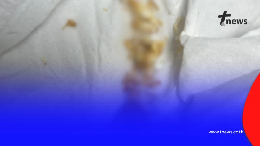 ตกใจ หมอเปิดเคสคนไข้หอบ "เศษผิว" ให้ดู อ้างมีแมลงไต่อยู่ในตัว