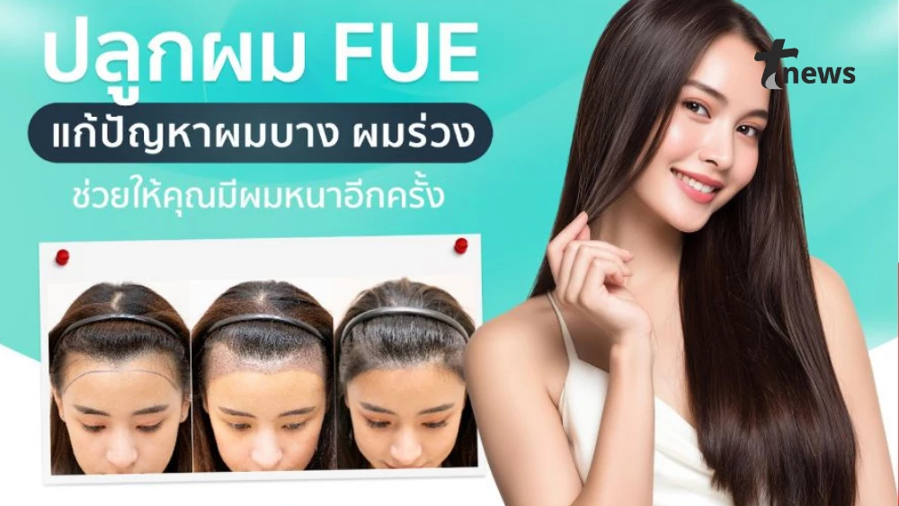 ปลูกผม FUE วิธีแก้ผมบาง ผมร่วง ไม่มีรอยแผลเป็นยาวให้กวนใจ