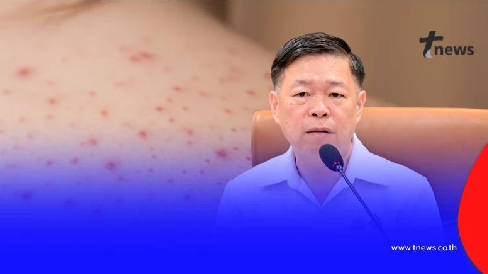 เปิดช่วงอายุ ที่ติด "อีสุกอีใส" มากสุด ล่าสุด คนติดสะสมเป็นหมื่น