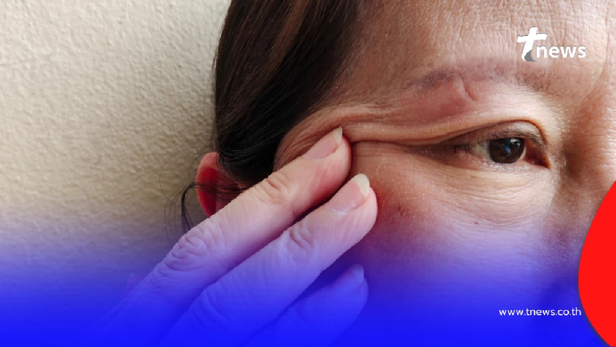 Sky Clinic ชำนาญการด้านศัลยกรรมตา ยกหางตาปรับรูปตา