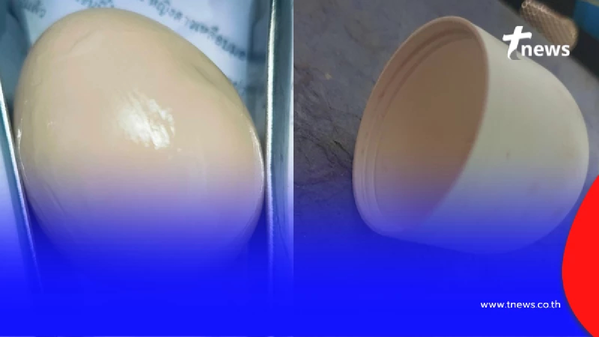 ผู้ป่วยมีสิ่งแปลกปลอมติดในช่องคลอด บางชิ้นหมอก็เพิ่งเคยเจอ