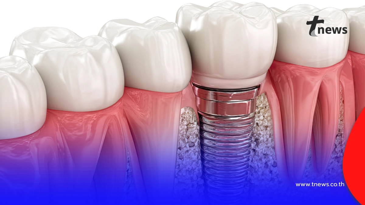 เจาะลึกทำรากฟันเทียม มีขั้นตอนอะไรบ้าง เตรียมงบเท่าไหร่ดี?