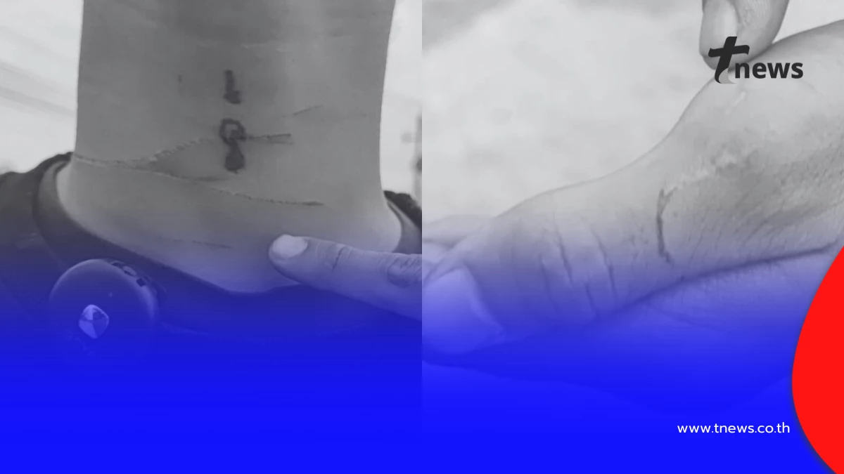 หนุ่ม 16 ลุยแจ้งความ หลังขี่มอเตอร์ไซค์เจอ "เชือกว่าว" รัดคอ