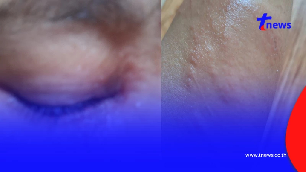 ระวังให้ดี เตือนแมลงตัวจิ๋วแต่พิษแรง โดนทีเดียวผิวไหม้สุดทรมาน