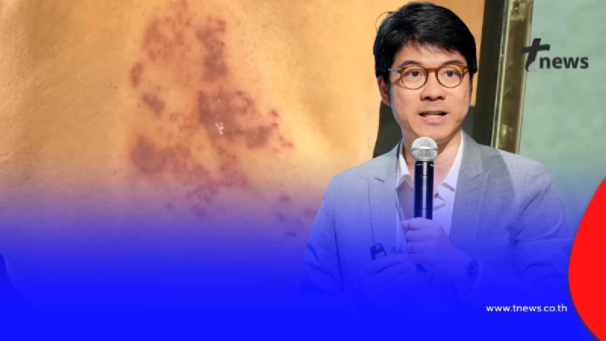 หลายคนไม่เคยรู้ สิ่งที่ตามมาหลัง "งูสวัด" หาย ยิ่งรู้ ยิ่งน่าตกใจ