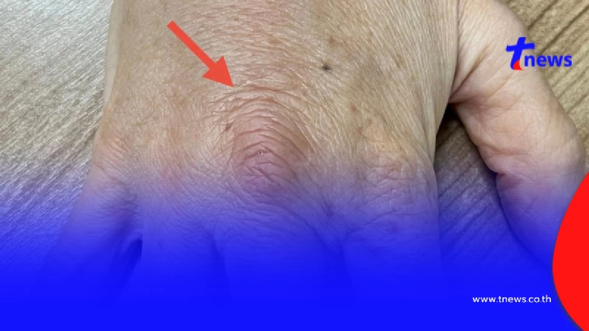 นั่นไง "หญิงอายุ 62" โดนหนามกุหลาบตำ สุดท้าย ไปตรวจ เจอจังๆ