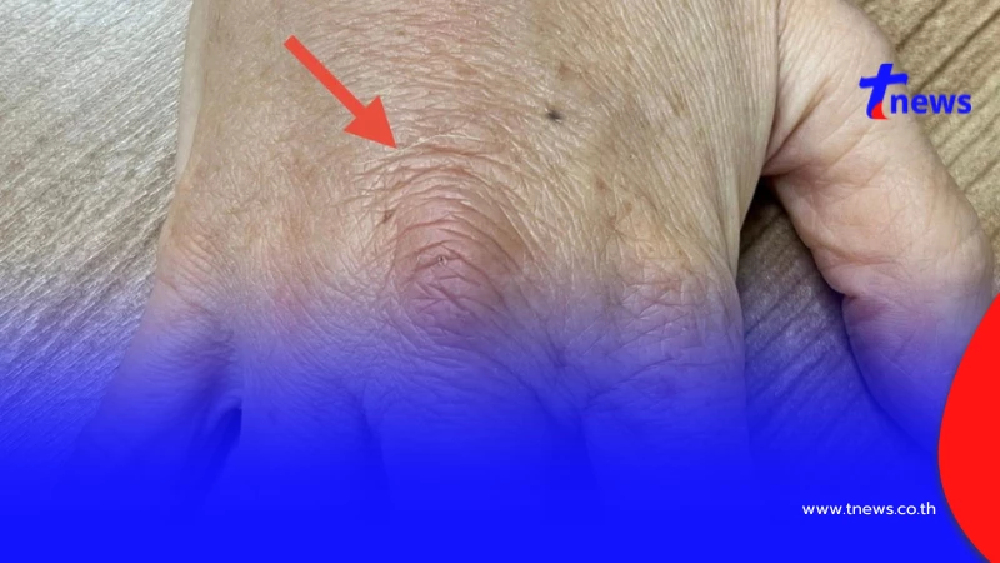 นั่นไง "หญิงอายุ 62" โดนหนามกุหลาบตำ สุดท้าย ไปตรวจ เจอจังๆ