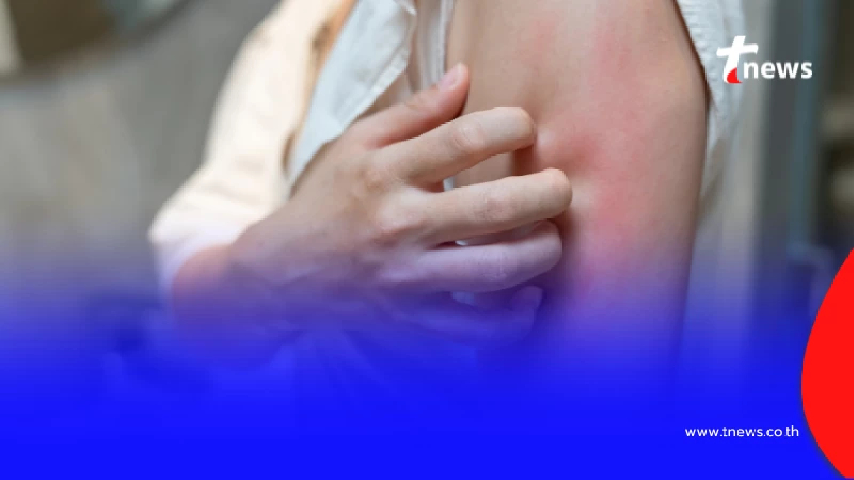 PM 2.5 ตัวการสิวเห่อ-ผื่นคัน เปิดวิธีป้องกันผิวอักเสบที่ถูกต้อง