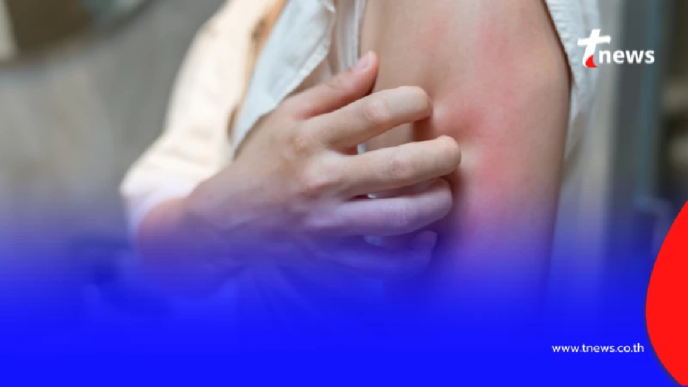 PM 2.5 ตัวการสิวเห่อ-ผื่นคัน เปิดวิธีป้องกันผิวอักเสบที่ถูกต้อง