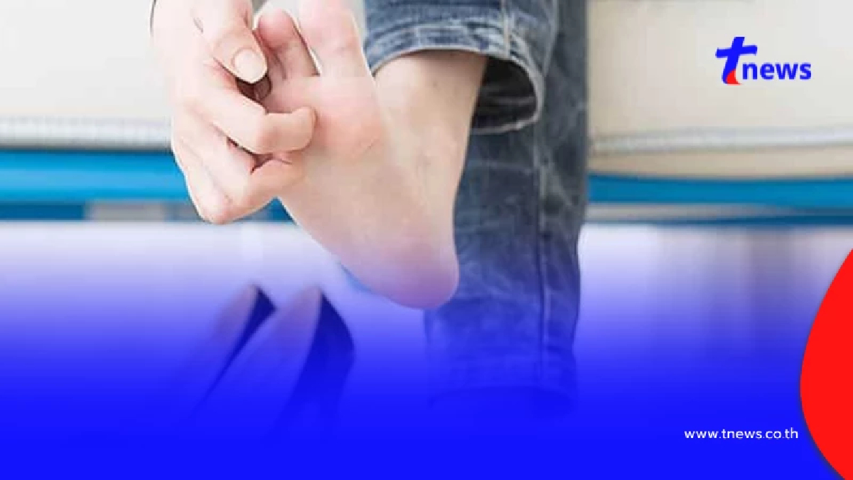 อย่ามองข้าม! “น้ำกัดเท้า” โรคเล็กที่อาจลุกลามจนรักษายาก