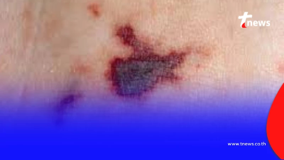 อย่าชะล่าใจ ไข้กาฬหลังแอ่นไทยพุ่งสูงสุดใน 10 ปี เด็กเล็ก-วัยรุ่นเสี่ยงสุด