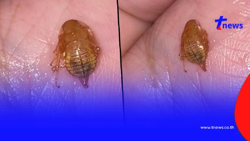 ขนหัวลุก นึกว่าแค่ระคายคอ สุดท้ายเจอ สัตว์สยอง ซ่อนอยู่ในร่างกาย