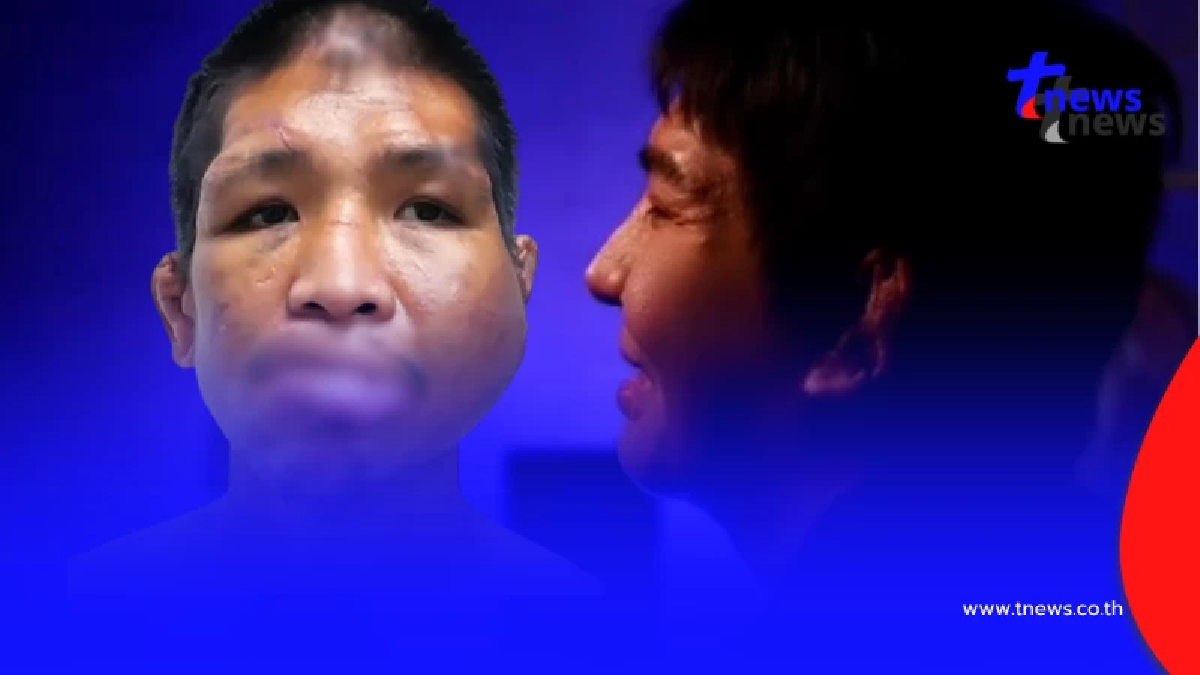 จำแทบไม่ได้ "น้องฟ้า โหนกระแส" ศัลยกรรม 4 ปี เหมือนได้เกิดใหม่