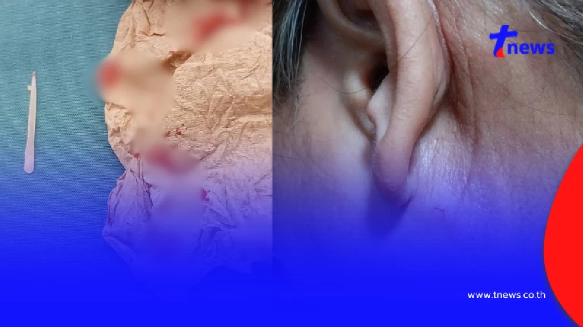ขนลุก "ก้างปลาติดคอ" อยู่ๆ โผล่ทะลุหลังหู เพจดังเตือนอันตรายมาก