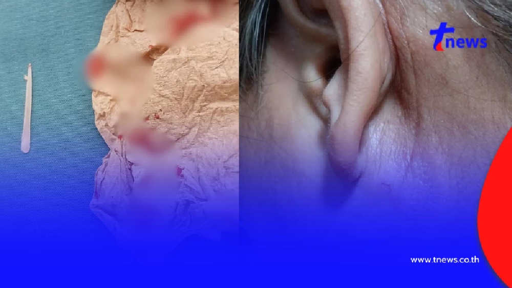 ขนลุก "ก้างปลาติดคอ" อยู่ๆ โผล่ทะลุหลังหู เพจดังเตือนอันตรายมาก