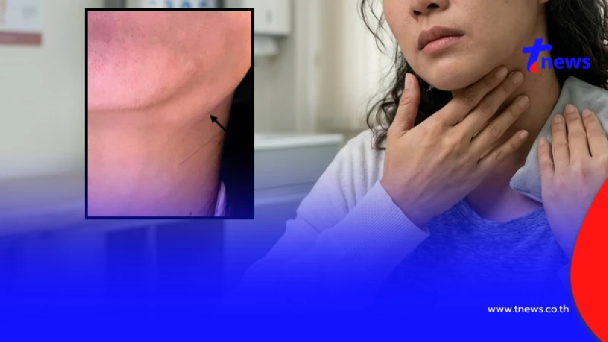 "หญิง31" พบต่อมน้ำเหลืองโต มา 3 เดือน สุดท้าย เจอเต็ม ๆ เป็นโรคหายาก