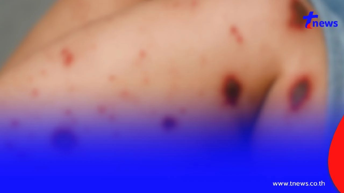 เตือนภัย "ไข้กาฬหลังแอ่น" ลุกลามไว เสี่ยงเสียชีวิตใน 24–48 ชม.