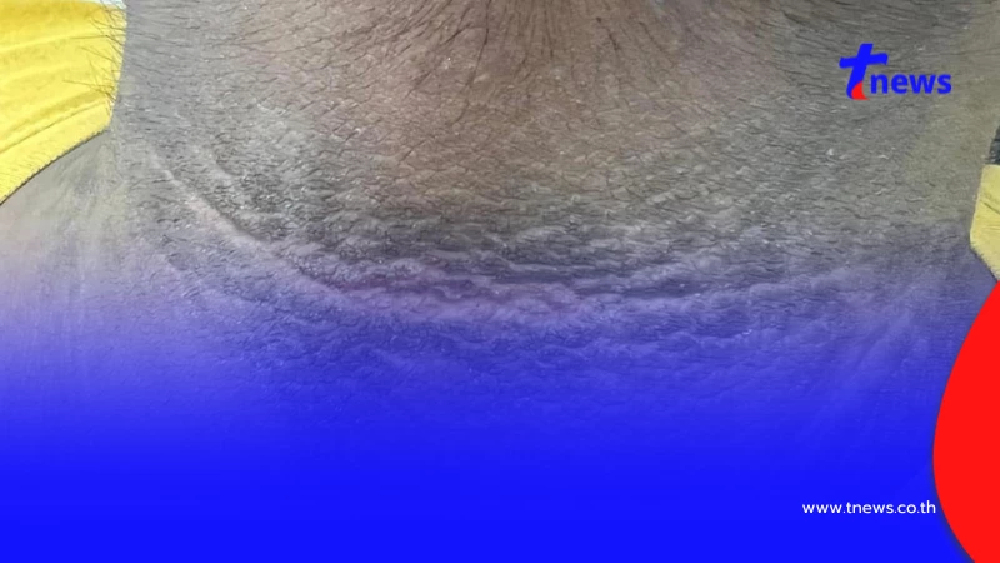 เปิดความจริง คอคาร์บอน แท้จริงคือสัญญาณอันตราย ต้องแก้ให้ตรงจุด