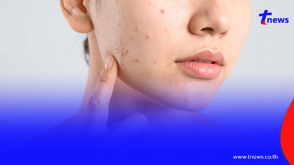 "งูสวัด" ไม่ใช่แค่ผื่น! เสี่ยงกระทบเส้นประสาท ลามถึงสมองได้