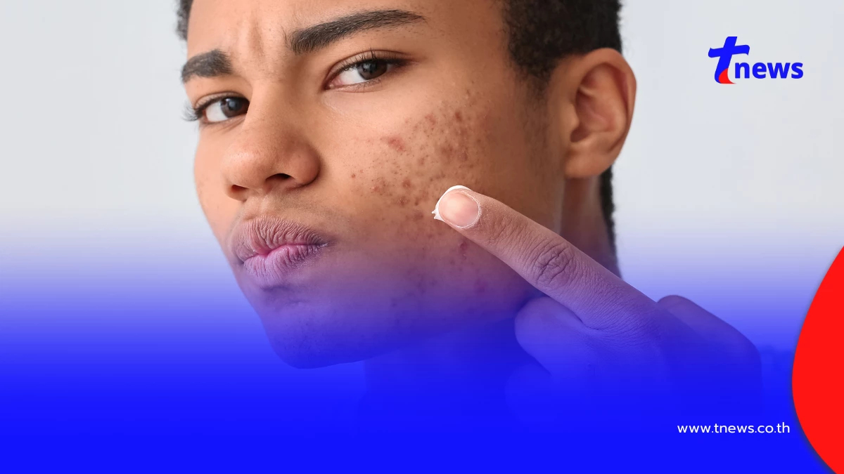 สิวขึ้นตรงไหน บอกอะไร? ถอดรหัส “แผนที่สิว” สัญญาณสุขภาพ