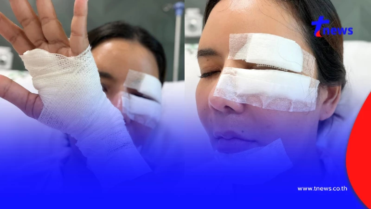 อุทาหรณ์ สาวให้อาหารหมาจร สุดท้ายโดนฝากเขี้ยวเย็บหน้า 50 เข็ม