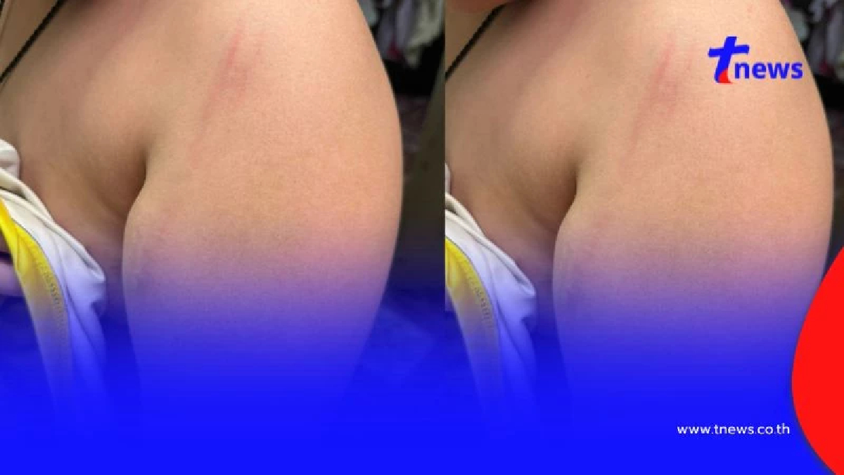 แม่แจ้งความเอาผิดครู ตีลูก ป.6 ไหล่บวมฟกช้ำ ใบรับรองแพทย์ยืนยัน