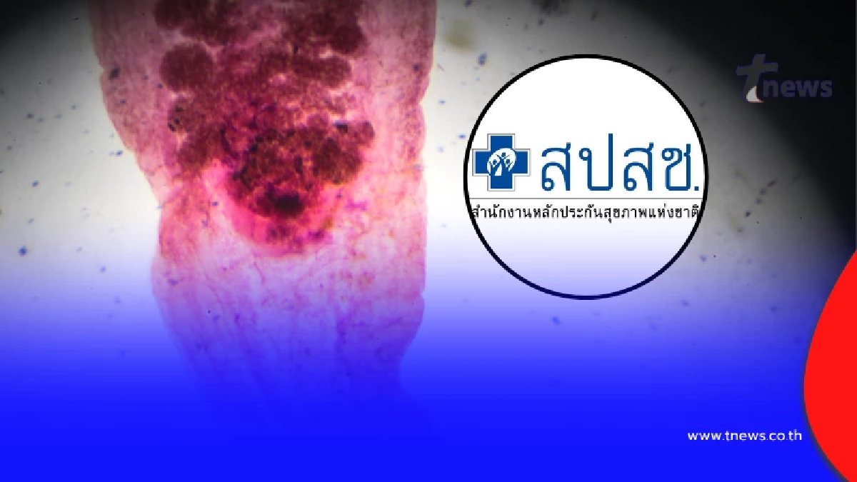 เผยวิธี "รับชุดตรวจพยาธิใบไม้ตับ" ฟรี แค่ 10 นาที รู้ผลเลย