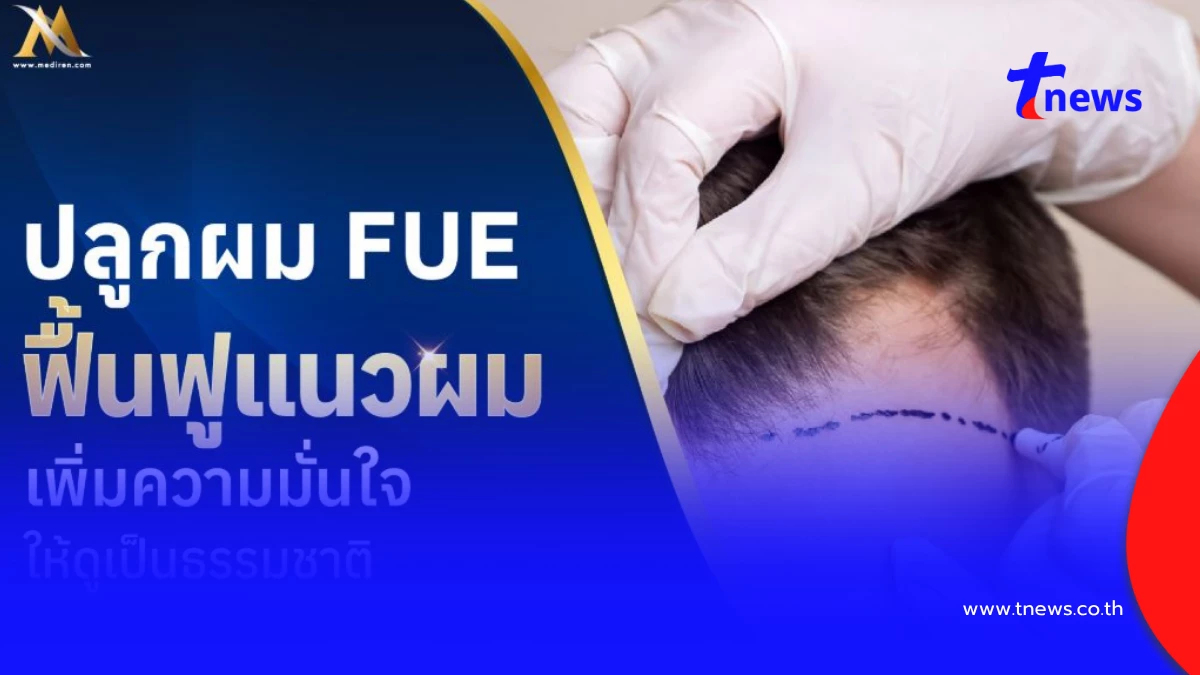 ปลูกผม FUE ดีไหม รู้จักเทคนิคฟื้นฟูเส้นผม ทางเลือกคนผมร่วง