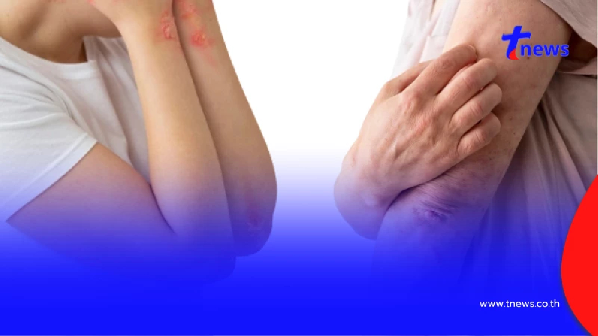 หลายคนยังเข้าใจผิด ระหว่าง HIV - เอดส์ สรุปแล้วยังรักษาได้มั้ย