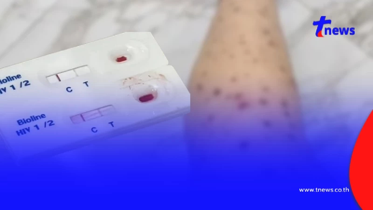 หลอนยกบ้าน อุทาหรณ์"จ้างพี่เลี้ยง" ตรวจเจอ HIV โรคแทรกซ้อนทำผวา