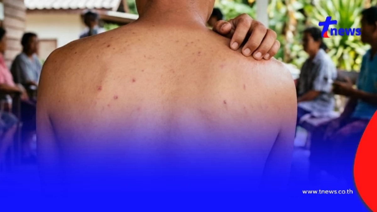 เตือน ใครมีอาการดังนี้ แล้ว "รักษาไม่หาย" ไปตรวจด่วน ระวัง HIV
