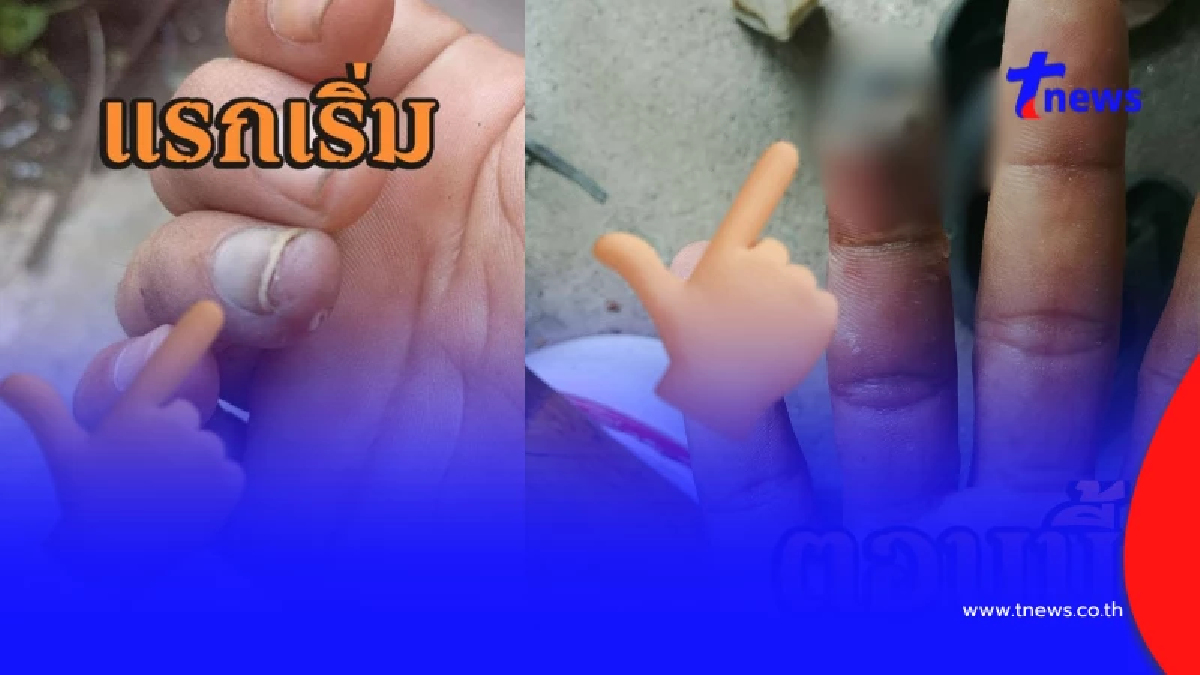 อย่าชะล่าใจ ปลายนิ้วดำ สัญญาณเตือนโรคร้าย คนสูบบุหรี่ต้องระวัง