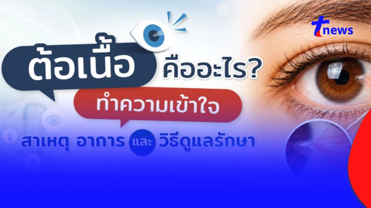 ต้อเนื้อคืออะไร? สาเหตุ อาการ และวิธีรักษาที่ควรรู้ก่อนตาพร่ามัว