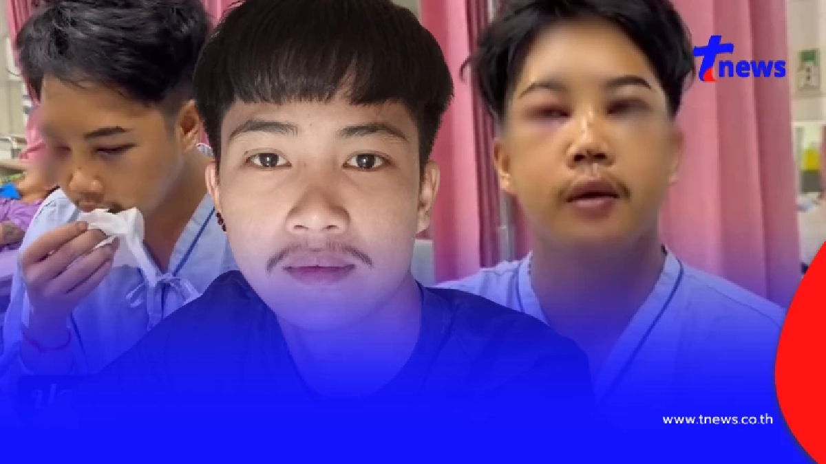 ตกใจแรง "บอล โดเรม่อน" ใบหน้าล่าสุด หลังประสบอุบัติเหตุ
