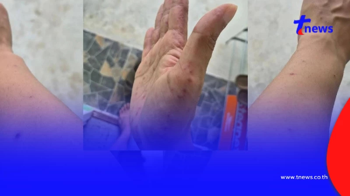 ใครจะคิด หนุ่มวัย 28 ป่วย "มือเท้าปาก" เข้าใจเลยเด็กทรมานขนาดไหน